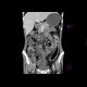 Crohn's disease involving colon, periproctal abscesses, enterography: CT - Computed tomography